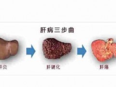 远离肝癌——这件事你真的做得到